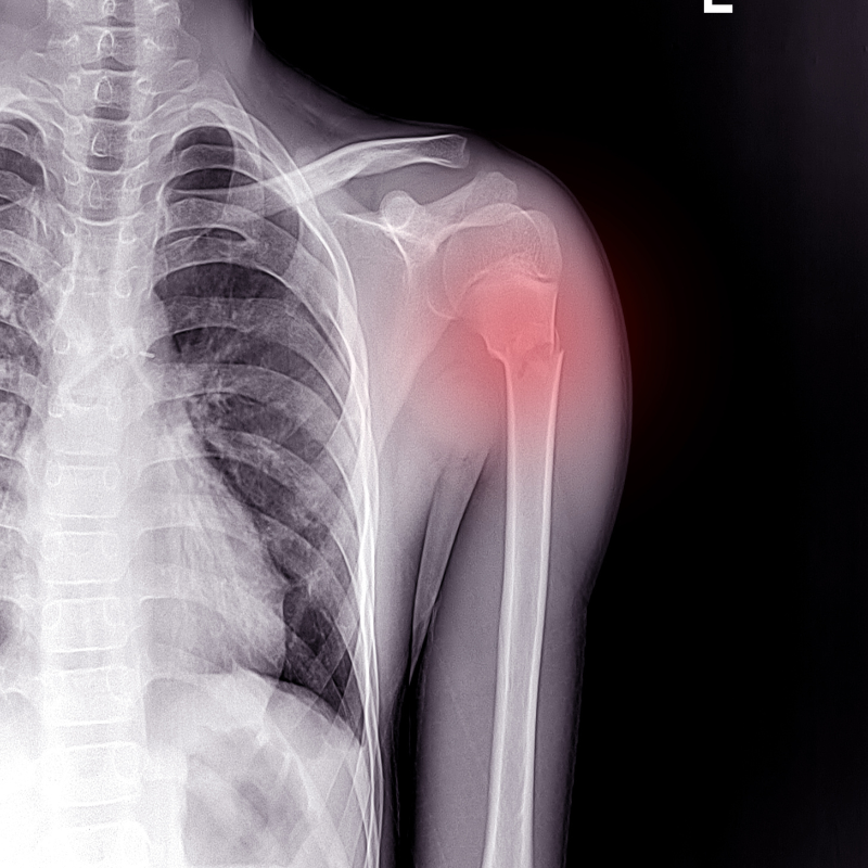 Gebroken ribben opgelopen? Claim uw schadevergoeding